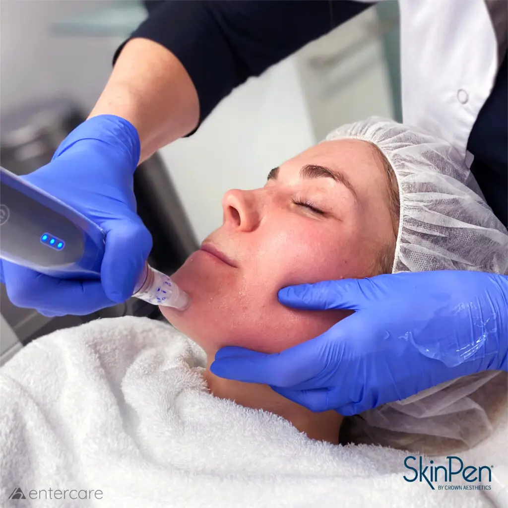 SkinPen behandeling