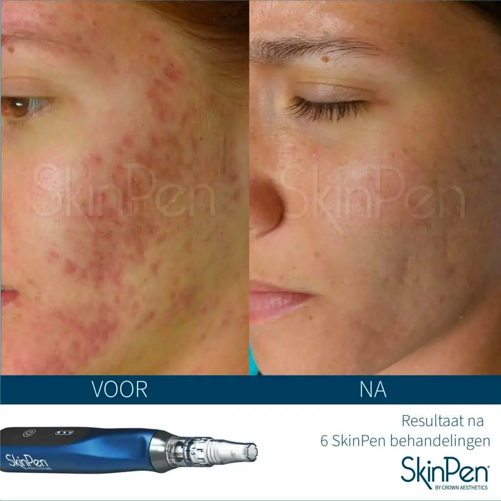 SkinPen voor en na vrouw jong
