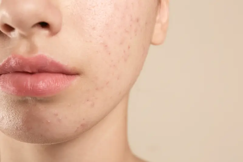 Acne behandeling