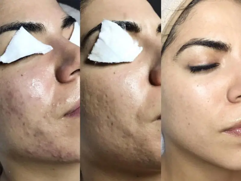 voordelen chemische peels