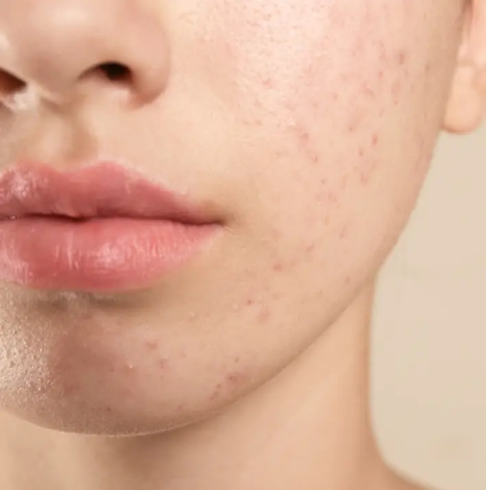Acne